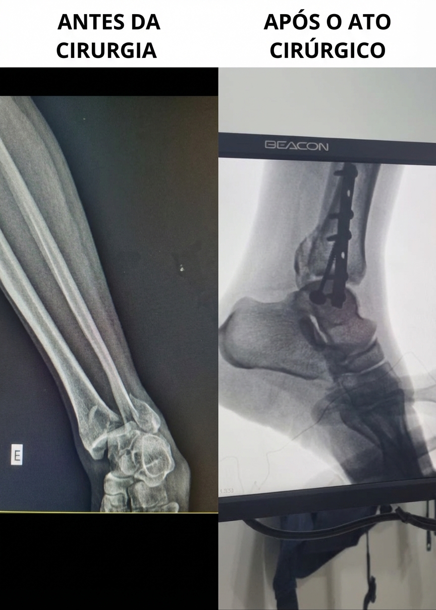 Da Fratura à Cirurgia em 7 Horas: Oiapoque vive nova realidade na saúde ortopédica - Foto 1
